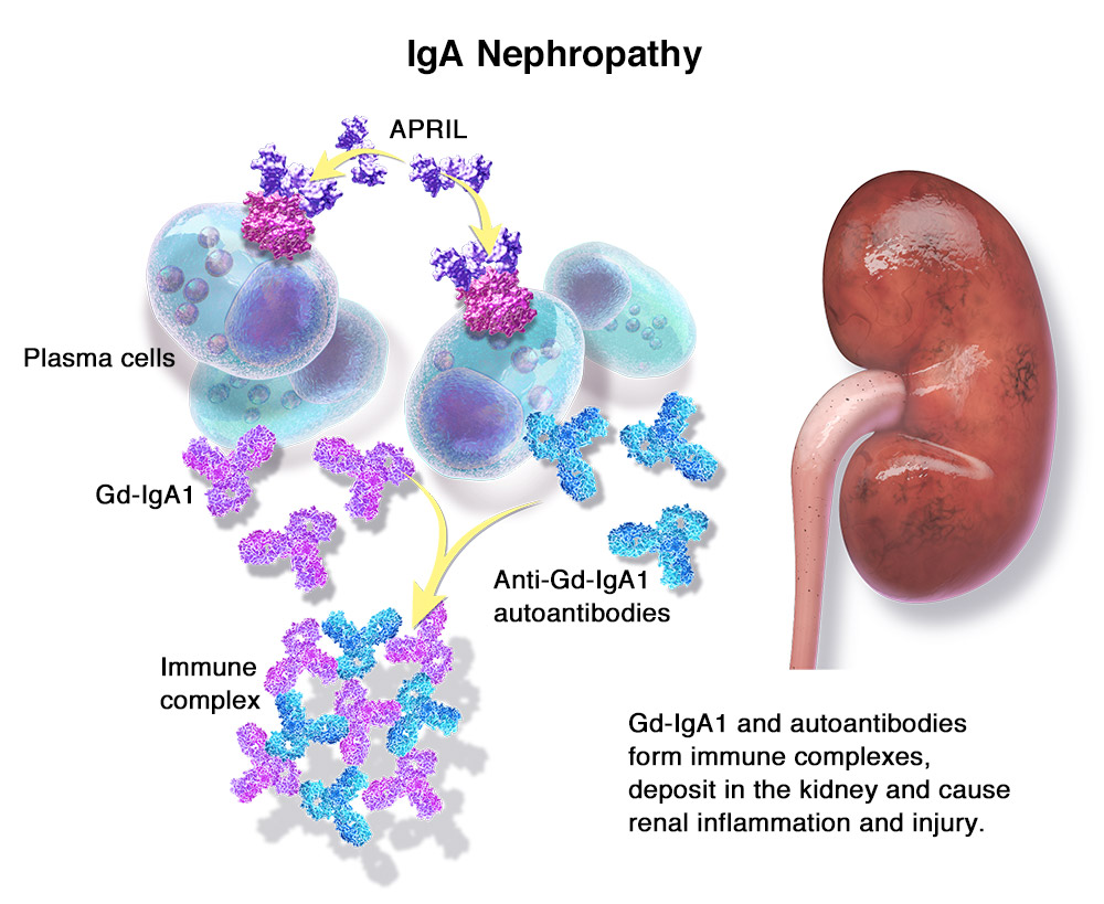 IgA nephropathy image